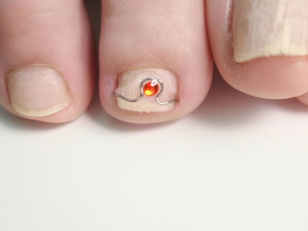 Spangentherapie bei eingewachsenem Nagel mittels Ross Frasa